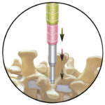 A diagram of the Medtronic METRx MicroDiscectomy System, showing the insertion of the device into a human spine. The system was invented by Dr. Gary K. Michelson.