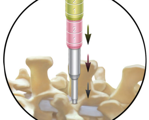 A diagram of the Medtronic METRx MicroDiscectomy System, showing the insertion of the device into a human spine. The system was invented by Dr. Gary K. Michelson.