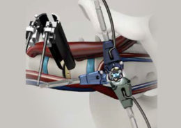 The Pivox Oblique Lateral Interbody Fusion Spinal System, created by Dr. Gary Michelson.