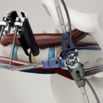 Dr. Gary K. Michelson invented the Pivox Oblique Lateral Spinal System with Lateral Plate for OLIF25 and Divergence-L Anterior/Oblique Lumbar Fusion System for OLIF51. This new device will improve the outcomes of certain types of spinal surgeries.