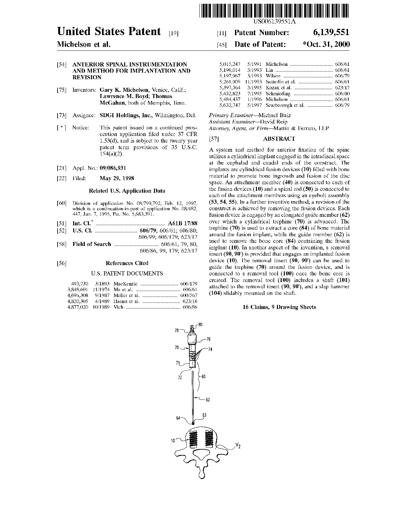 Anterior spinal instrumentation and method for implantation and revision - Patent 6,139,551
